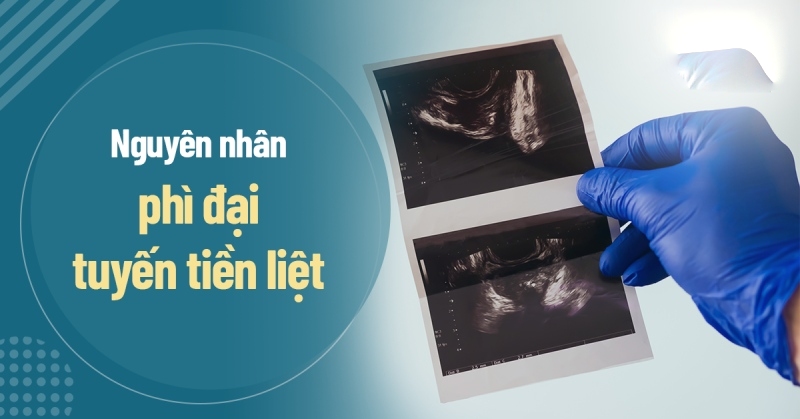 9 nguyên nhân phì đại tuyến tiền liệt và triệu chứng thường gặp