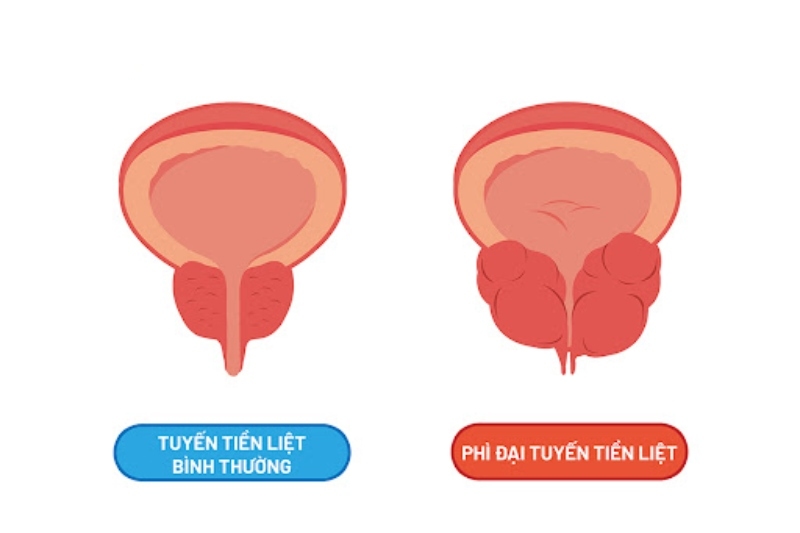 phì đại và tiền liệt tuyến bình thường