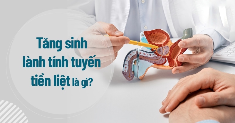 Tăng sinh lành tính tuyến tiền liệt: Nguyên nhân, cách điều trị