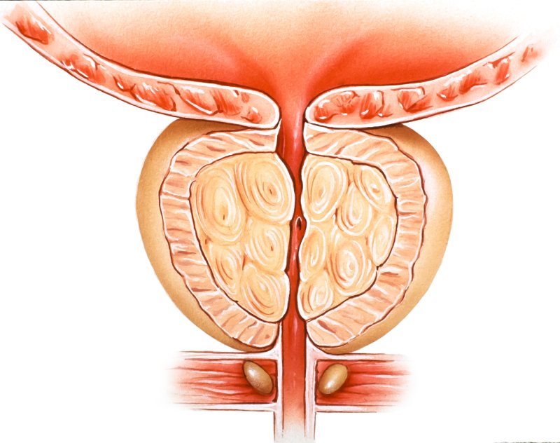 tuyến tiền liệt gây chèn ép lên niệu đạo