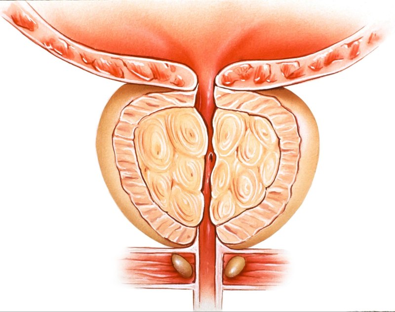 điều trị nội khoa được áp dụng cho bph nhẹ và trung bình