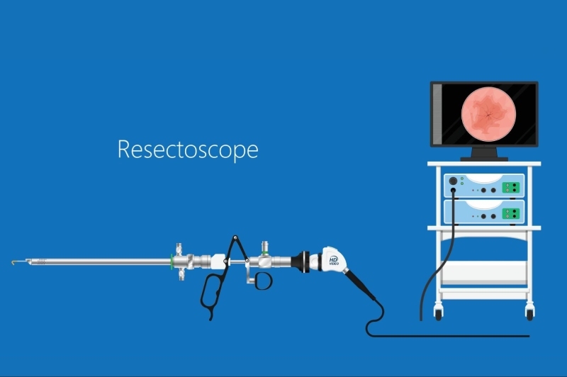 mổ nội soi tiền liệt tuyến