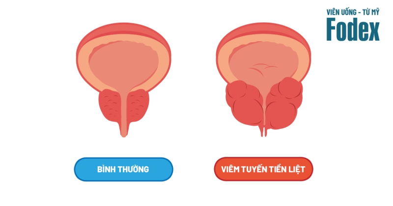tuyến tiền liệt bình thường và tuyến tiền liệt bị viêm