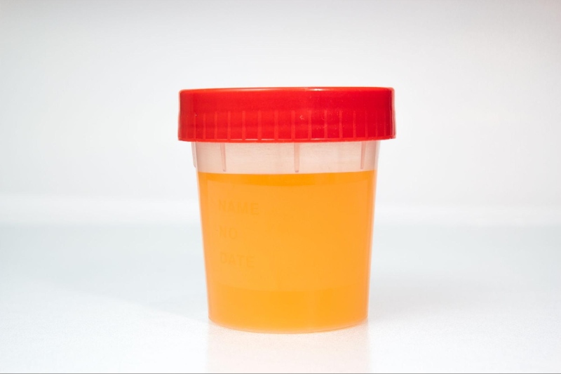 nước tiểu màu cam có thể do nước tiểu quá đặc