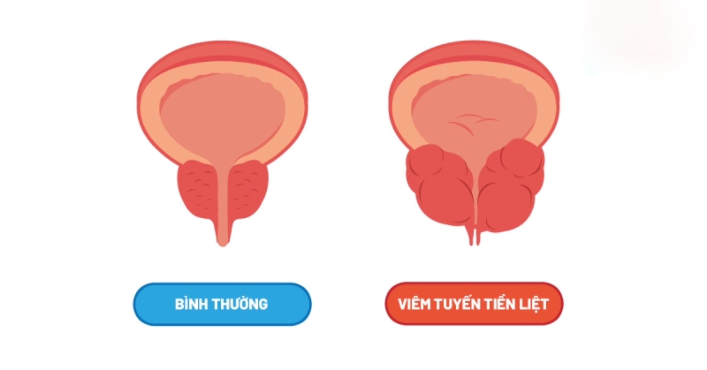 tiền liệt tuyến bình thường và viêm