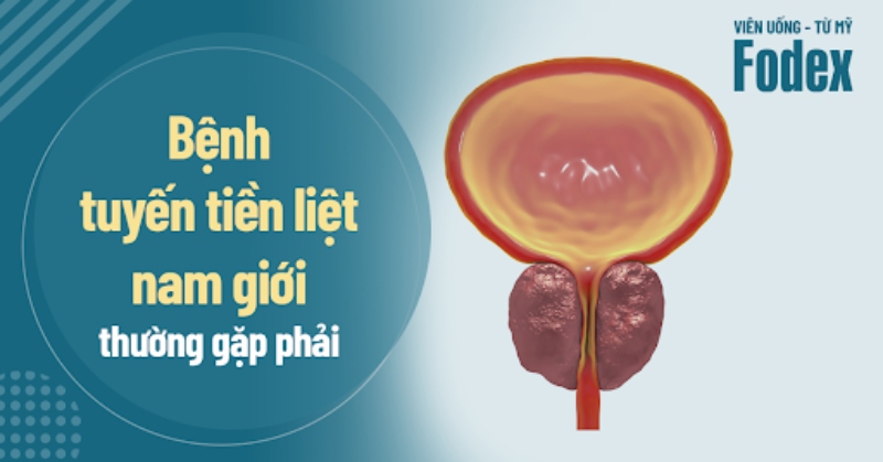 5 bệnh tiền liệt tuyến nam giới thường gặp phải, dấu hiệu dễ nhận biết
