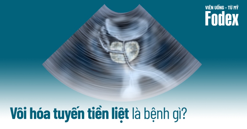 Bệnh vôi hóa tuyến tiền liệt là bệnh gì? Nguyên nhân do đâu?