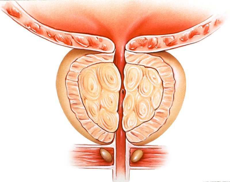 phì đại lành tính tuyến tiền liệt gây ra tiểu đêm