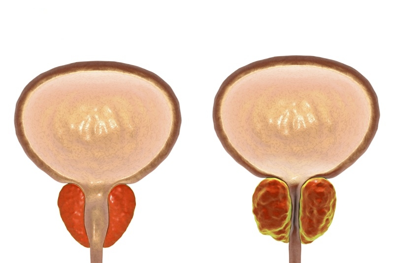 phì đại tiền liệt tuyến dưới