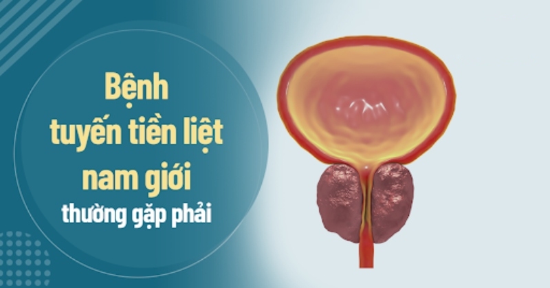 bệnh tiền liệt tuyến ở nam