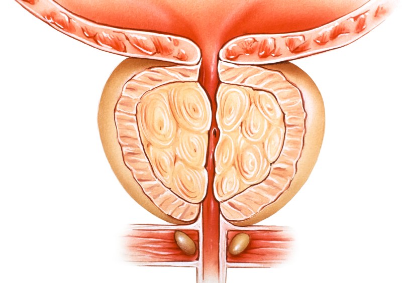 Phì đại tuyến tiền liệt cũng khiến đi tiểu nhiều