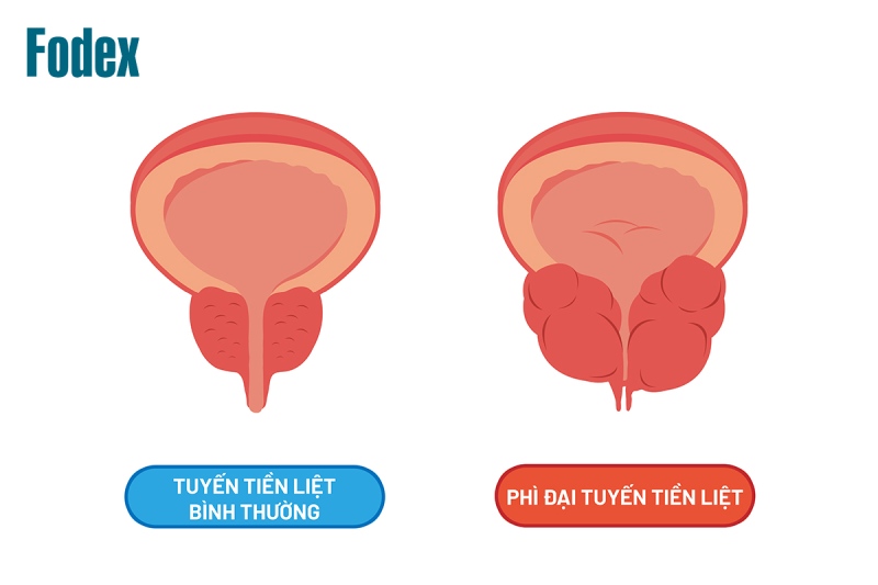 phì đại tuyến tiền liệt là nguyên nhân gây tiểu đêm nhiều lần