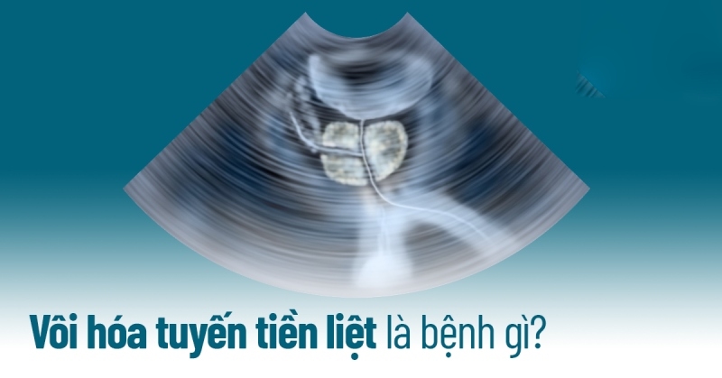 Bệnh vôi hóa tuyến tiền liệt là bệnh gì? Nguyên nhân do đâu?