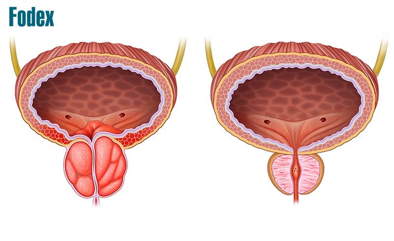 Bệnh phì đại lành tính tuyến tiền liệt