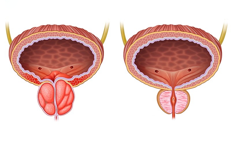 bệnh phì đại tiền liệt tuyến