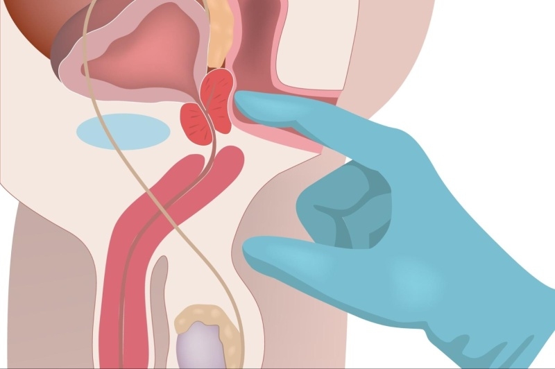 kích thích tiền liệt tuyến nam giới