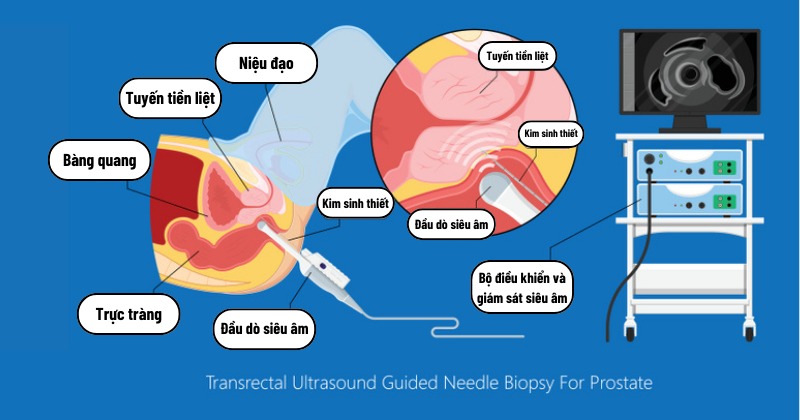 Siêu âm tuyến tiền liệt qua trực tràng