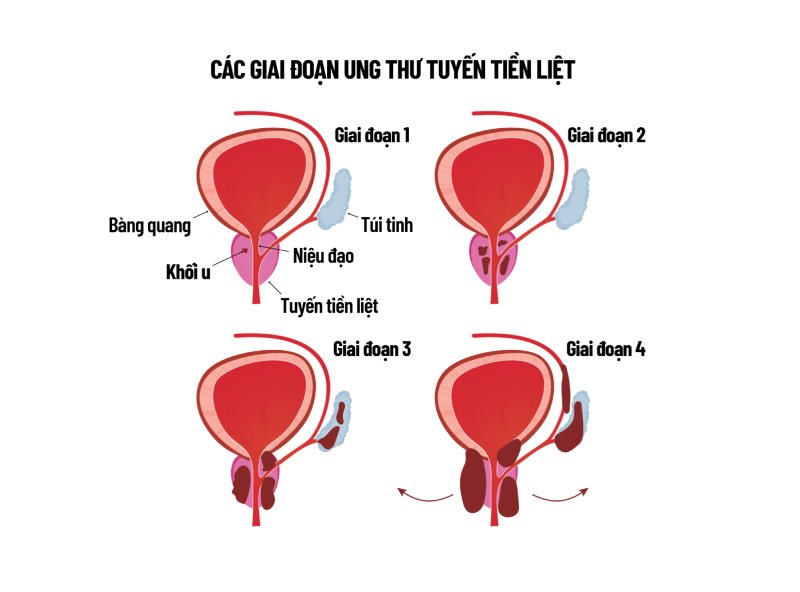Các giai đoạn tiến triển của ung thư tuyến tiền liệt