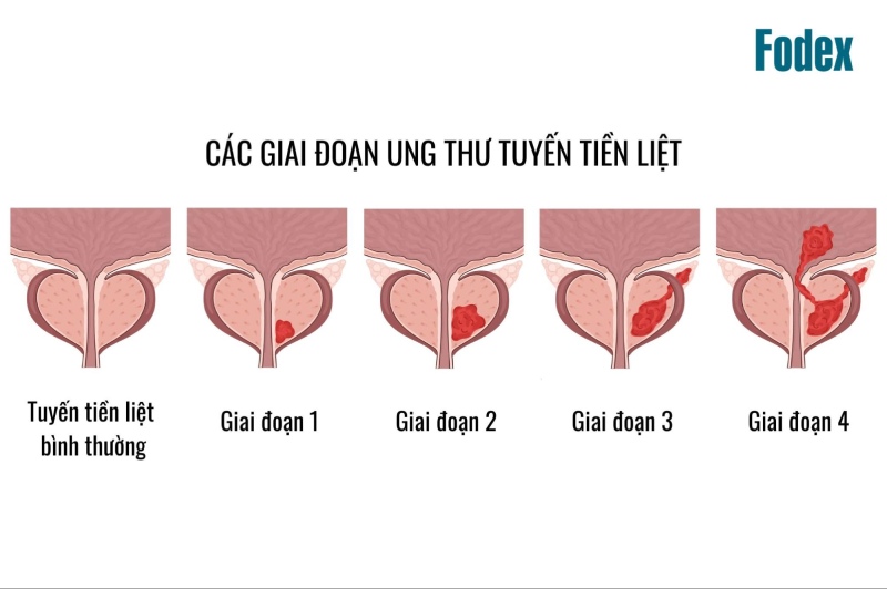 Các giai đoạn ung thư tuyến tiền liệt