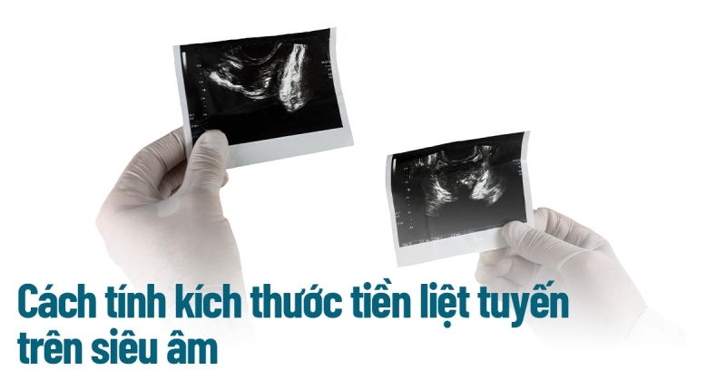 Cách tính kích thước tiền liệt tuyến trên siêu âm được bác sĩ sử dụng
