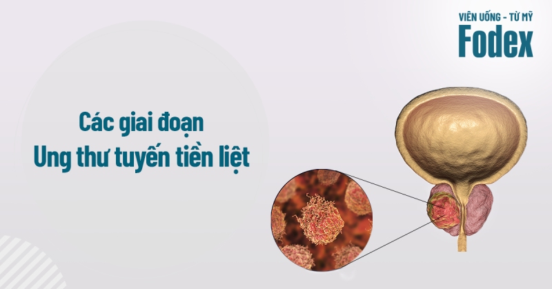4 giai đoạn ung thư tuyến tiền liệt và phương pháp điều trị hiệu quả