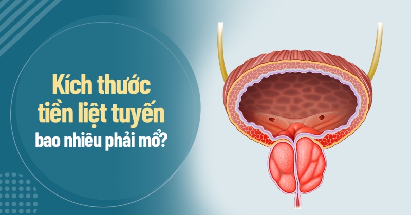 Kích thước tiền liệt tuyến bao nhiêu phải mổ