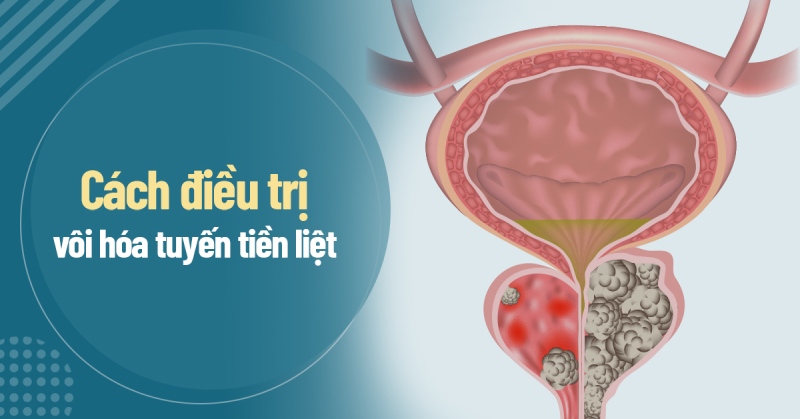 3 cách điều trị vôi hóa tuyến tiền liệt đúng, an toàn và hiệu quả cao