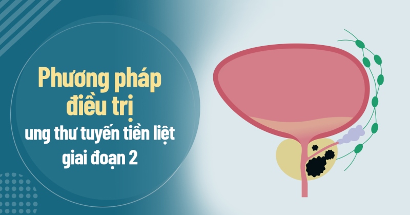 Cách điều trị ung thư tuyến tiền liệt giai đoạn 2 hiệu quả, an toàn