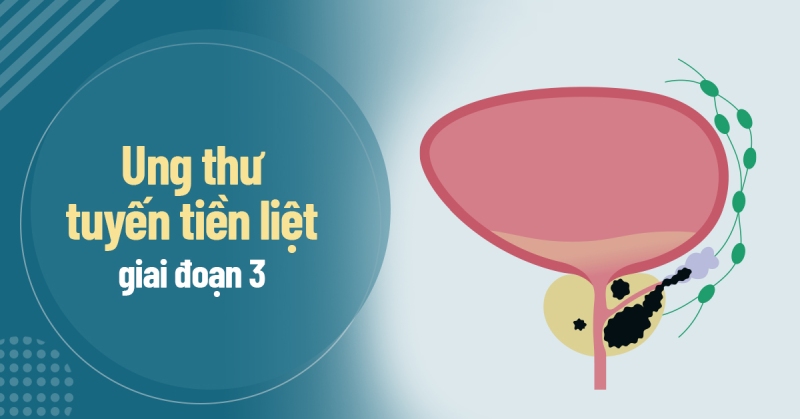 Ung thư tuyến tiền liệt giai đoạn 3: Chẩn đoán và cách điều trị