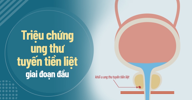Triệu chứng ung thư tuyến tiền liệt giai đoạn đầu và cách điều trị