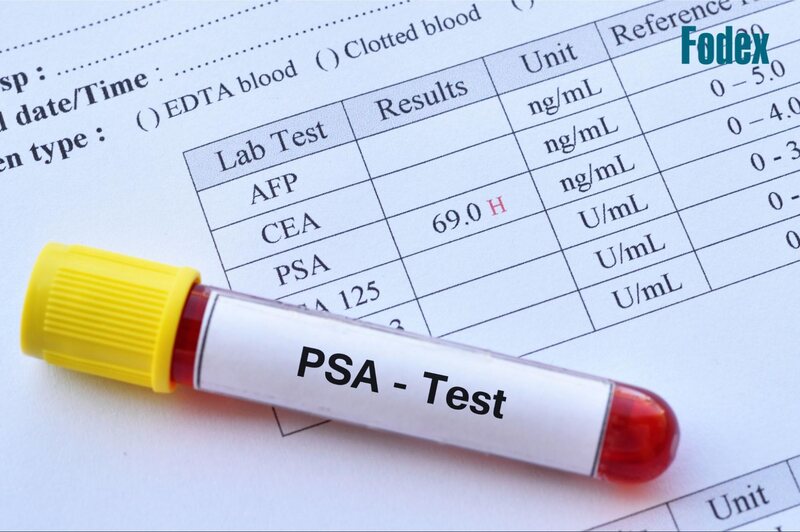 xét nghiệm chỉ số psa