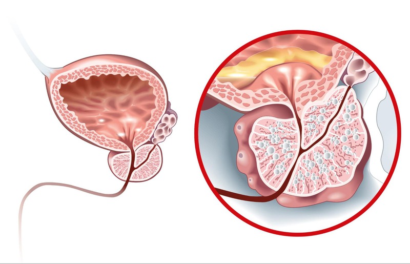 phì đại lành tính tuyến tiền liệt