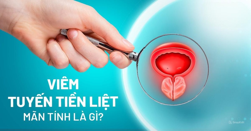 Bệnh viêm tuyến tiền liệt mãn tính là gì? Dấu hiệu và cách điều trị