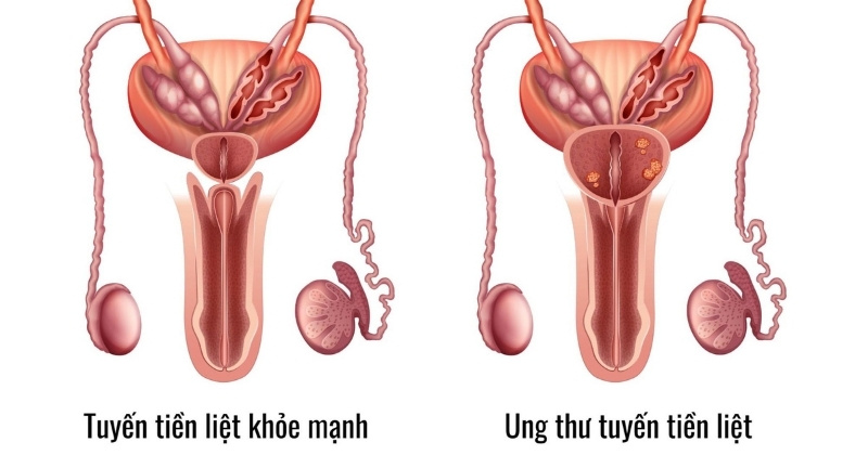 so sánh tuyến tiền liền bình thường và ung thư