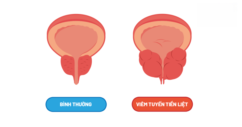 viêm tuyến tiền liệt ảnh hưởng đến bí tiểu