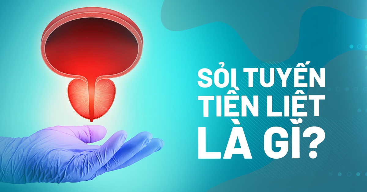 Sỏi tuyến tiền liệt: Nguyên nhân, dấu hiệu bệnh và phòng ngừa