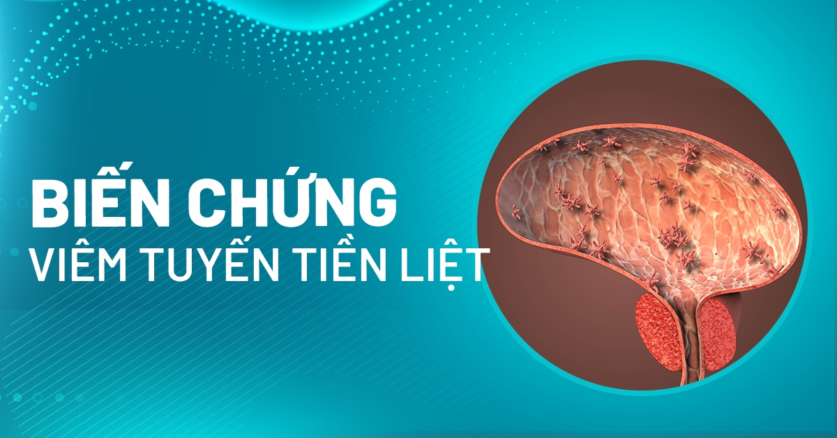 Cảnh báo: Biến chứng viêm tuyến tiền liệt và mức độ nguy hiểm