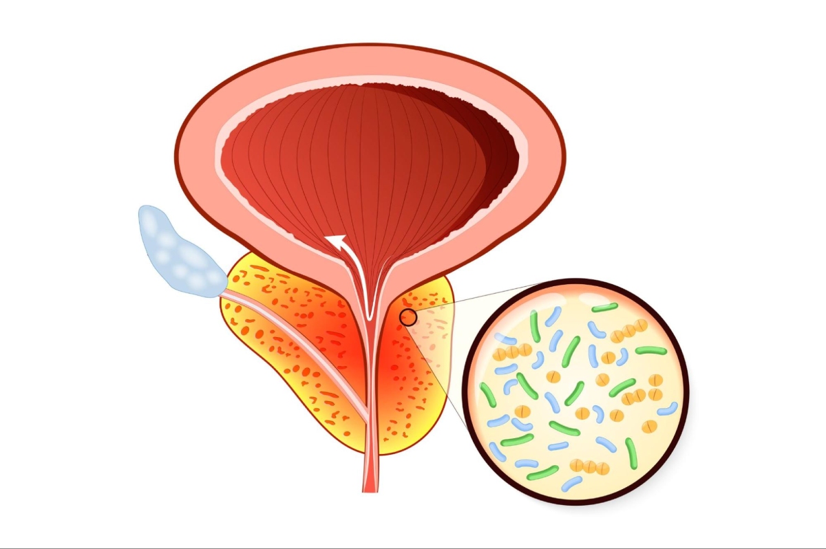 vi khuẩn trong tuyến tiền liệt