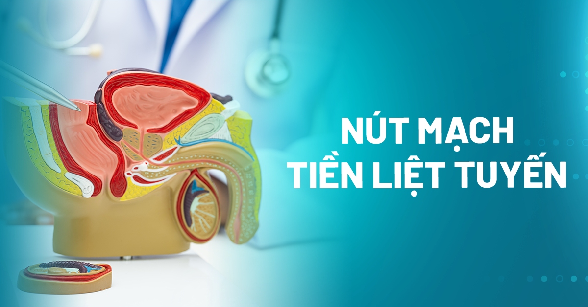 Phương pháp nút mạch tiền liệt tuyến: Quy trình và chỉ định