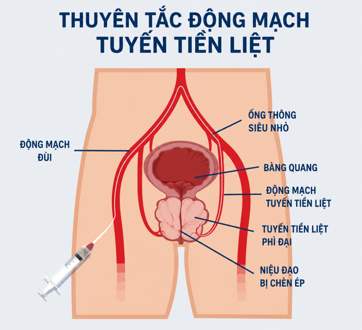 sơ đồ và đường truyền khi tiêm hạt vi cầu siêu nhỏ
