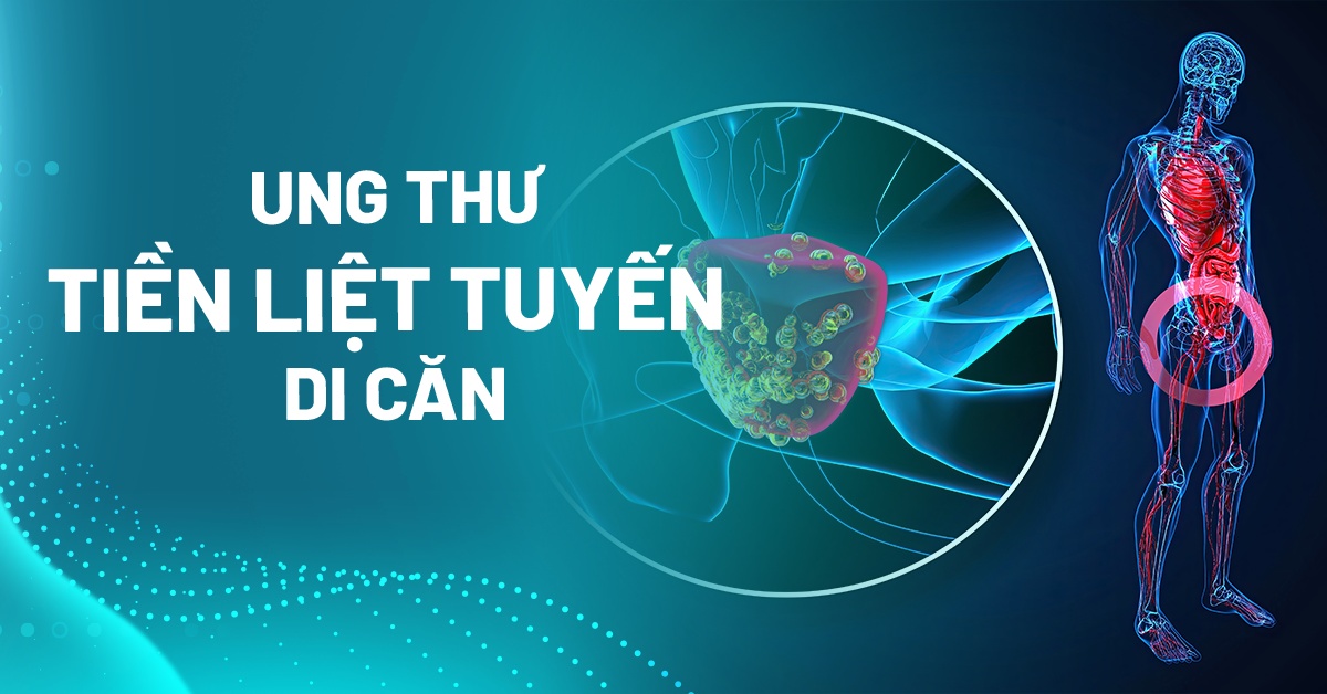 Ung thư tiền liệt tuyến di căn đến các bộ phận nào?