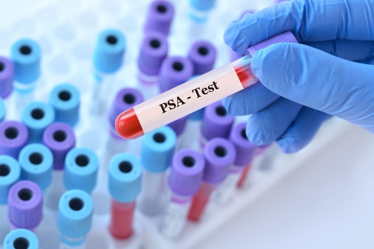xét nghiệm psa chẩn đoán ung thư tuyến tiền liệt